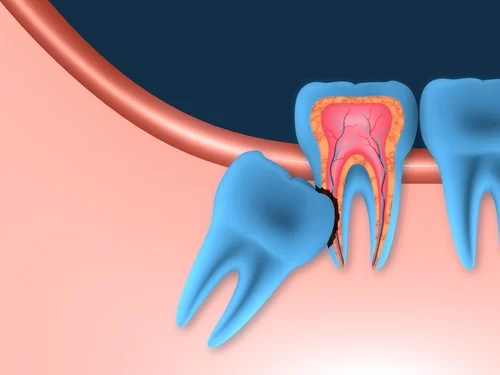 Terceros molares 4 Icor Terceros molares Daño a dientes vecinos