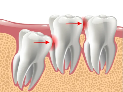 Terceros molares 5 Icor Terceros molares Problemas de alineaciòn