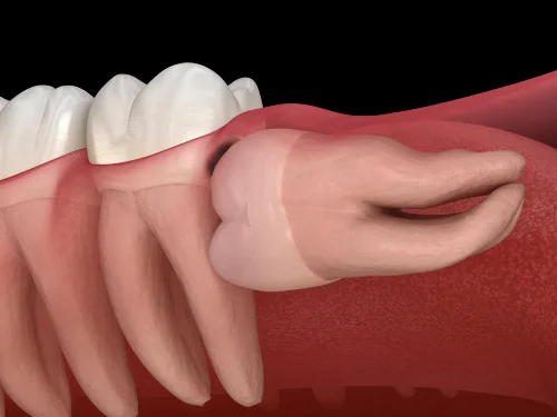 Terceros molares 3 Icor - Terceros molares, Deterioro