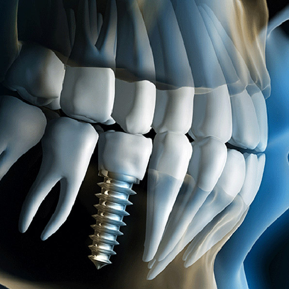 Implantes Dentales ICOR