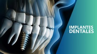 implantes ICOR Anatomía de dientes sanos e implantes dentales en la dentadura humana. Ilustración 3d