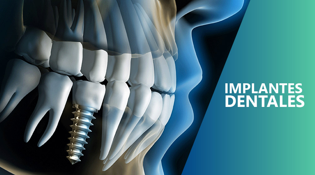 disculpa Aburrir Acostumbrar implantes ICOR Anatomía de dientes sanos e implantes dentales en la dentadura  humana. Ilustración 3d - ICOR