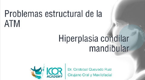 Hiperplasia condilar mandibular