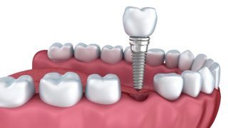 Anatomía de dientes sanos e implantes dentales en la dentadura humana. Ilustración 3d