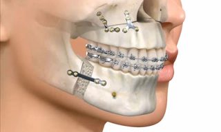 Miniplacas, Microtornillos, Anclaje Esqueletal para ortodoncia