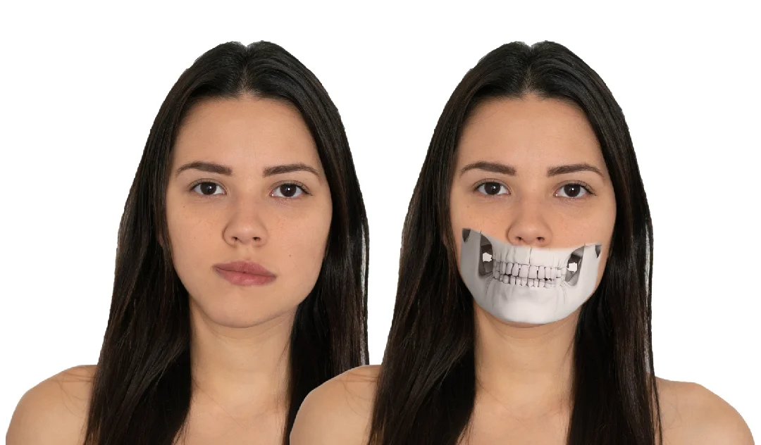 Asimetrias faciales, anomalías, clase II, Clase III, Sonrisa Gingival - Icor