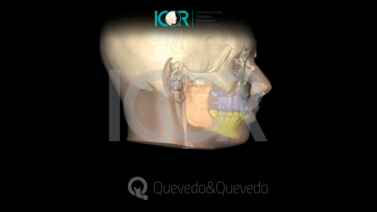 Prognatismo Mandibular o Clase 3 » Cirugía Ortognática - Instituto