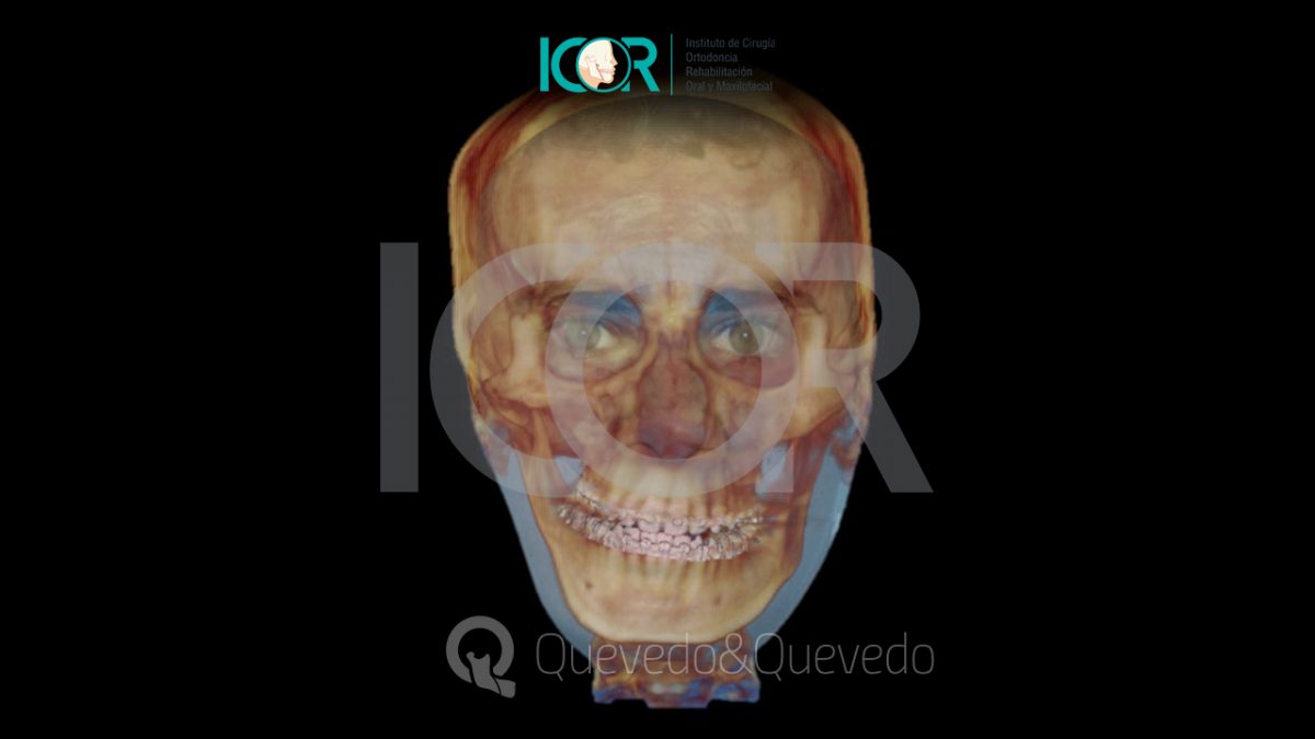 Tipos de anomalías que se corrigen con cirugía ortognática 38 Asimetria Facial - Cirugía