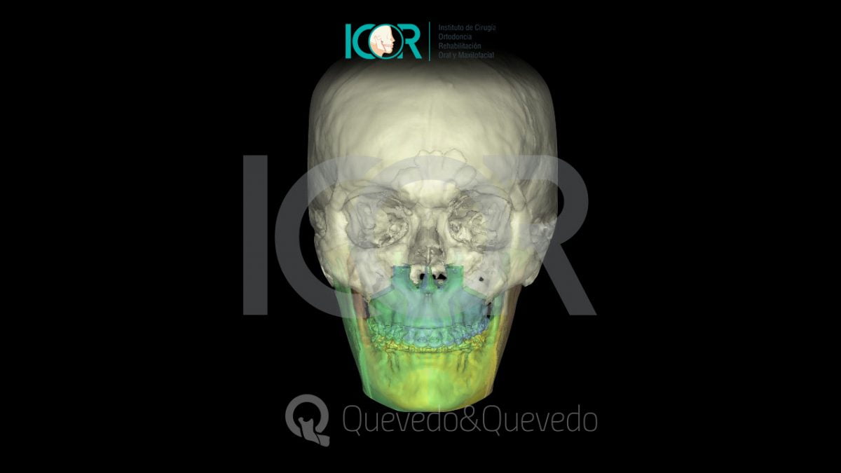 Tipos de anomalías que se corrigen con cirugía ortognática 47 Asimetria Facial - Cirugía
