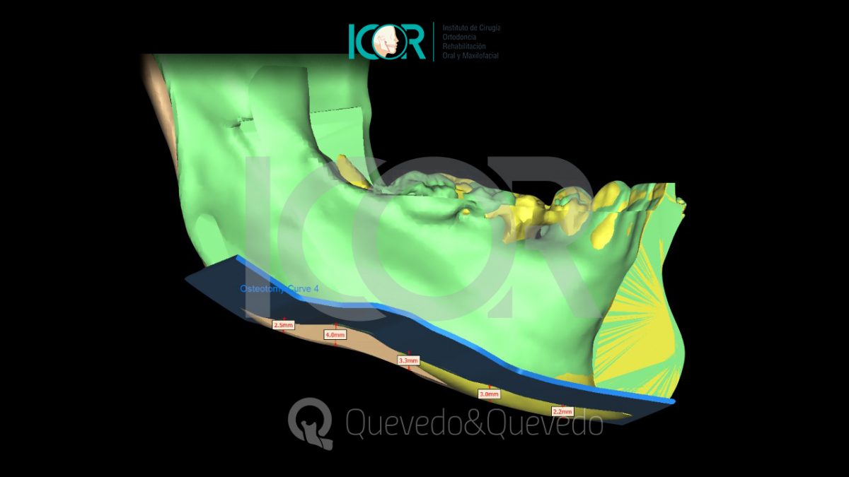 Tipos de anomalías que se corrigen con cirugía ortognática 48 Asimetria Facial - Cirugía