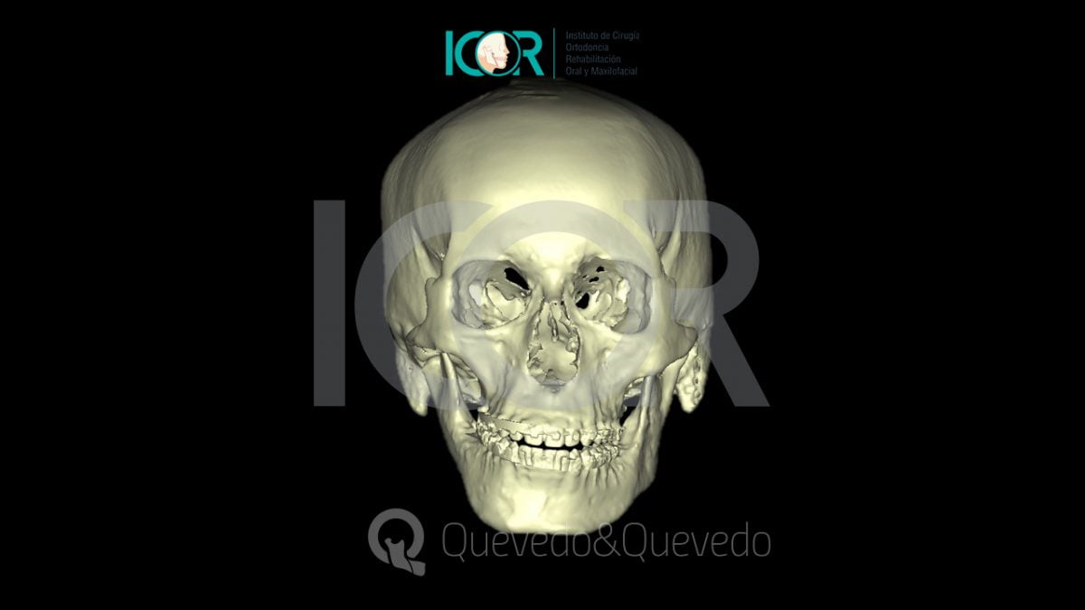 Tipos de anomalías que se corrigen con cirugía ortognática 39 Asimetria Facial - Cirugía