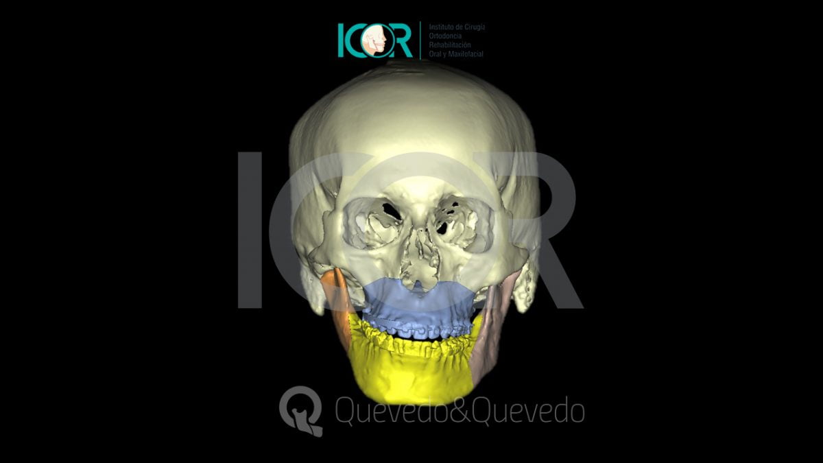 Tipos de anomalías que se corrigen con cirugía ortognática 40 Asimetria Facial - Cirugía