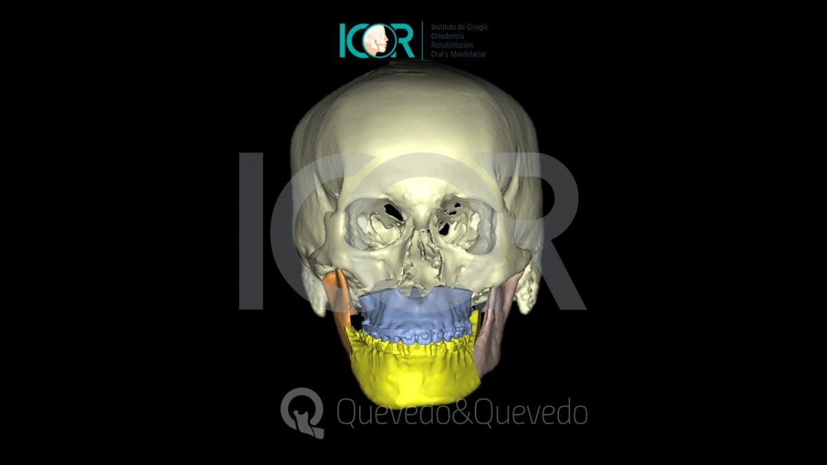 Tipos de anomalías que se corrigen con cirugía ortognática 41 Asimetria Facial - Cirugía