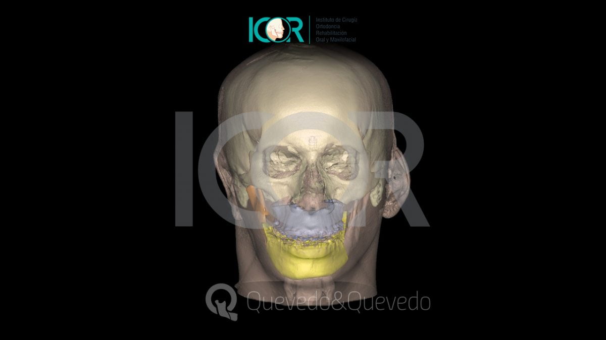 Tipos de anomalías que se corrigen con cirugía ortognática 42 Asimetria Facial - Cirugía