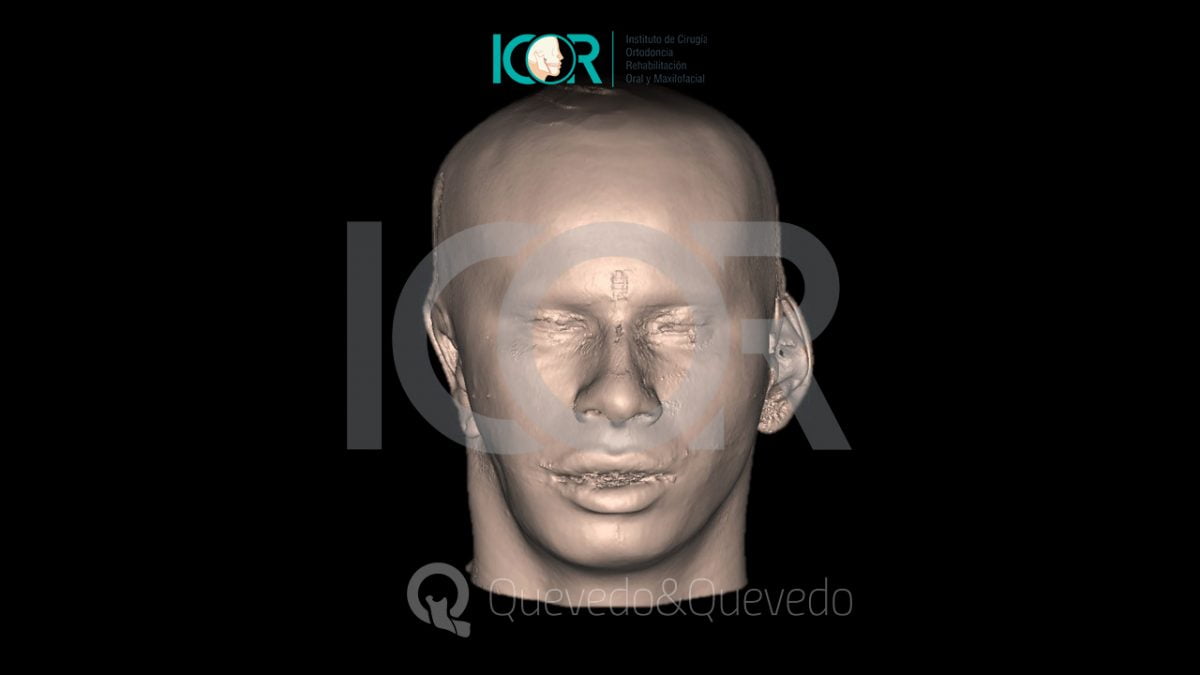 Tipos de anomalías que se corrigen con cirugía ortognática 44 Asimetria Facial - Cirugía