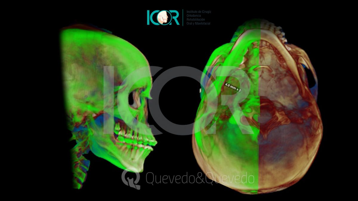 Tipos de anomalías que se corrigen con cirugía ortognática 45 Asimetria Facial - Cirugía