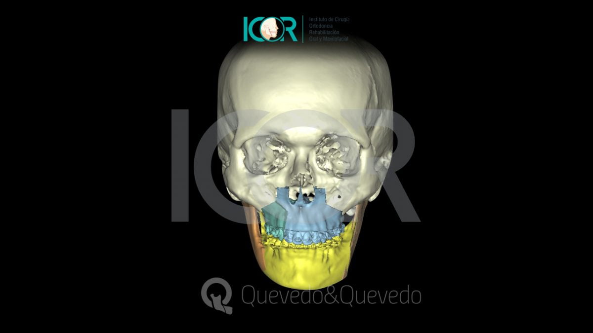 Tipos de anomalías que se corrigen con cirugía ortognática 46 Asimetria Facial - Cirugía