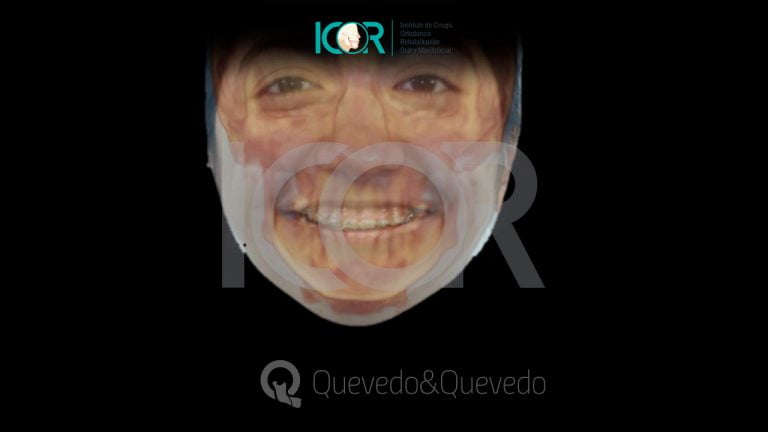 Tipos de anomalías que se corrigen con cirugía ortognática 50 Sonrisa Gingival