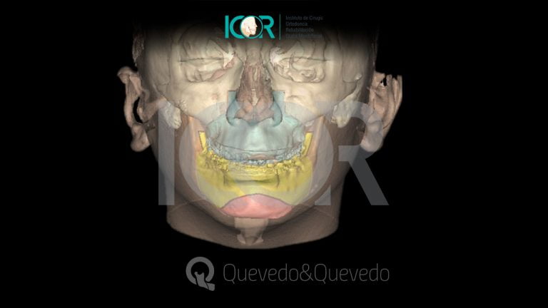 Tipos de anomalías que se corrigen con cirugía ortognática 59 Sonrisa Gingival