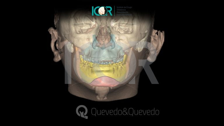 Tipos de anomalías que se corrigen con cirugía ortognática 60 Sonrisa Gingival