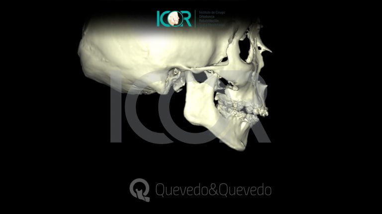 Tipos de anomalías que se corrigen con cirugía ortognática 61 Sonrisa Gingival