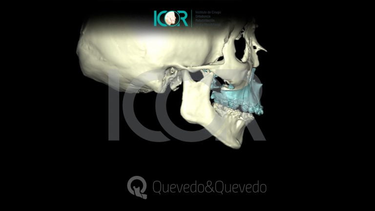 Tipos de anomalías que se corrigen con cirugía ortognática 62 Sonrisa Gingival