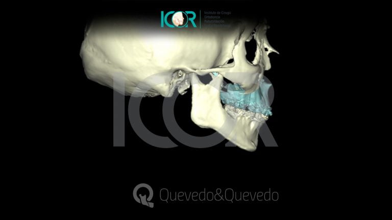 Tipos de anomalías que se corrigen con cirugía ortognática 63 Sonrisa Gingival