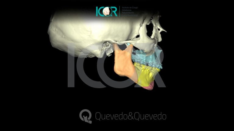 Tipos de anomalías que se corrigen con cirugía ortognática 64 Sonrisa Gingival