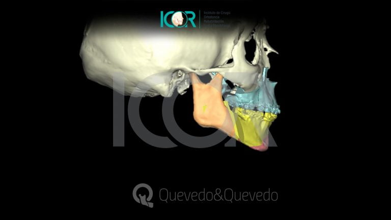 Tipos de anomalías que se corrigen con cirugía ortognática 65 Sonrisa Gingival