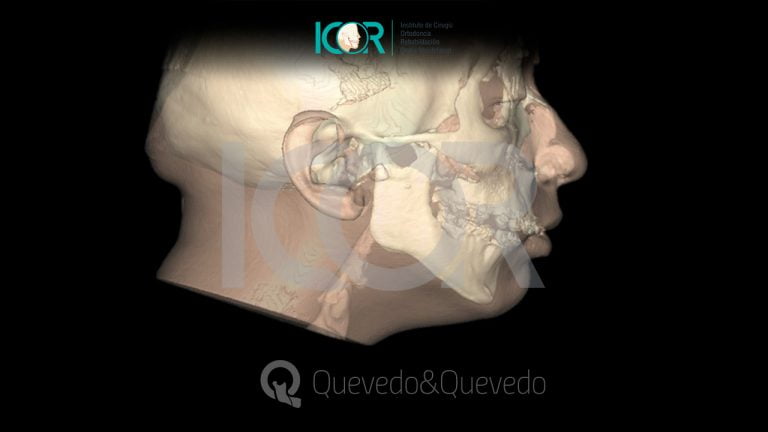 Tipos de anomalías que se corrigen con cirugía ortognática 66 Sonrisa Gingival