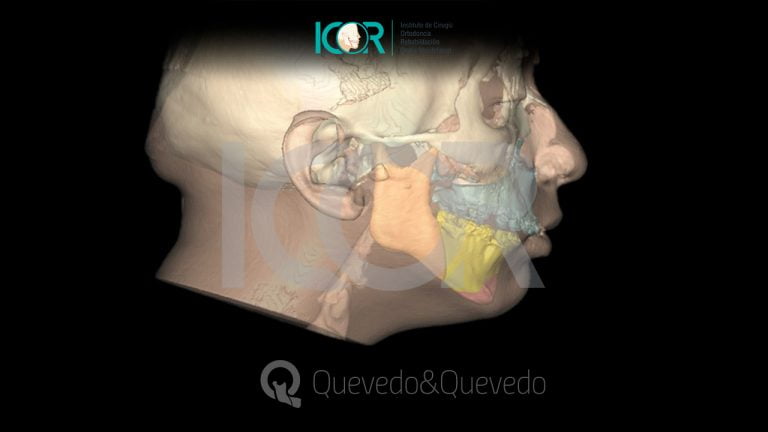 Tipos de anomalías que se corrigen con cirugía ortognática 67 Sonrisa Gingival