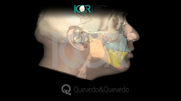 Tipos de anomalías que se corrigen con cirugía ortognática 68 Sonrisa Gingival