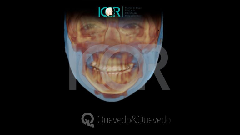 Tipos de anomalías que se corrigen con cirugía ortognática 51 Sonrisa Gingival
