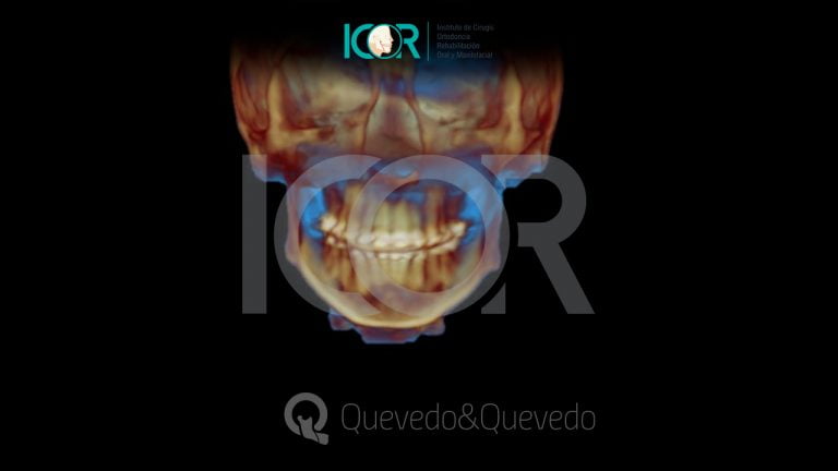 Tipos de anomalías que se corrigen con cirugía ortognática 52 Sonrisa Gingival