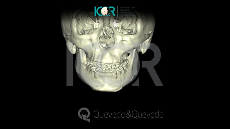 Tipos de anomalías que se corrigen con cirugía ortognática 53 Sonrisa Gingival