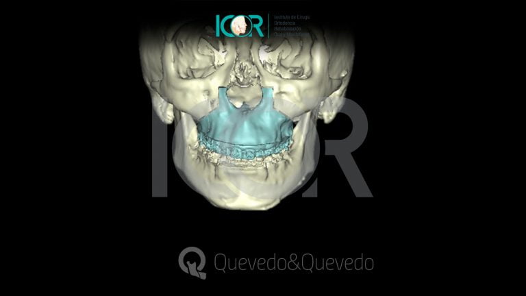 Tipos de anomalías que se corrigen con cirugía ortognática 54 Sonrisa Gingival