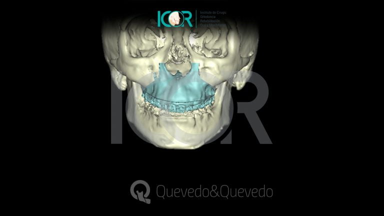 Tipos de anomalías que se corrigen con cirugía ortognática 55 Sonrisa Gingival