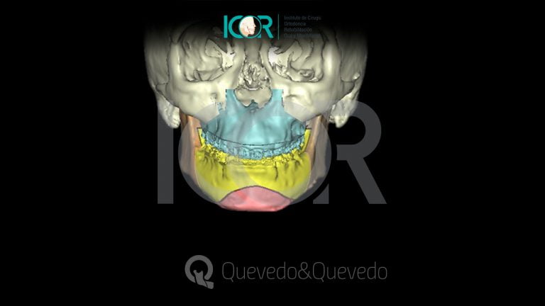 Tipos de anomalías que se corrigen con cirugía ortognática 56 Sonrisa Gingival