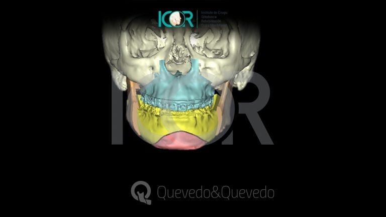 Tipos de anomalías que se corrigen con cirugía ortognática 57 Sonrisa Gingival