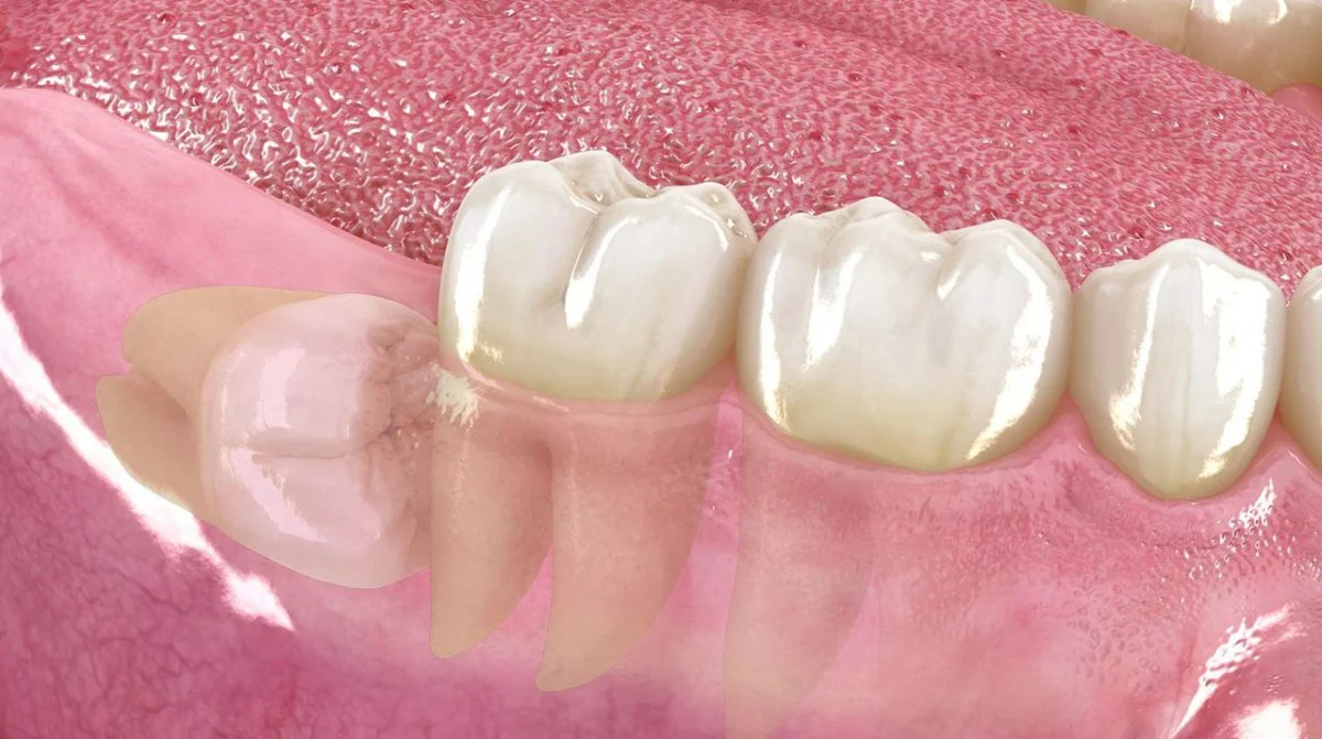 Terceros molares 1 Terceros molares, muelas del juicio, cirugia maxilofacial, cirugia oral, dr. cristóbal quevedo, cirugia bucal, cordales, dentista chile, tercer molar, ortognática, icor, icoracademy, osteotomía