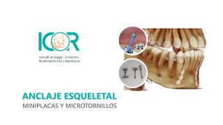 Anclaje Esqueletal - Microtornillos y miniplacas - ICOR