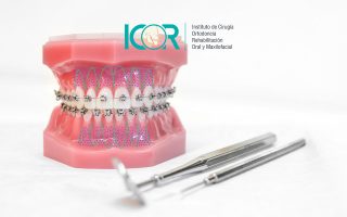 Ortodoncia ostegénica acelerada - Corticotomía - ICOR - La ortodoncia osteogénica acelerada llega para ser un complemento valioso para acortar los tiempos de tratamientos de ortodoncia. Consiste en aumentar el rango de movimiento del diente dentro del hueso a través de pequeños cortes en la mandíbula o maxilar.