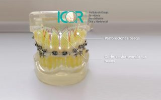 Ortodoncia ostegénica acelerada - Corticotomía - ICOR