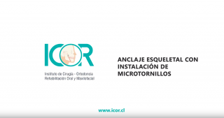 Video de procedimiento donde se muestra la instalación de microtornillos como anclaje para ortodoncia. icoracademy, cristobal quevedo, icor, miniplacas, microtornillos, anclaje esqueletal, cirugia maxilofacial, cirugia oral