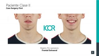 Cirugia Primero - Caso Clase II - Fotografías extraorales frontales