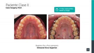 cirugía primero - comparativa antes y después de la cirugía - fotografias intraorales