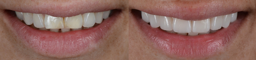 Antes y después carillas dentales