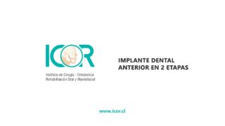 Implante dental anterior en 2 etapas
