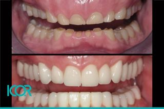 Antes y después Desgaste dentario