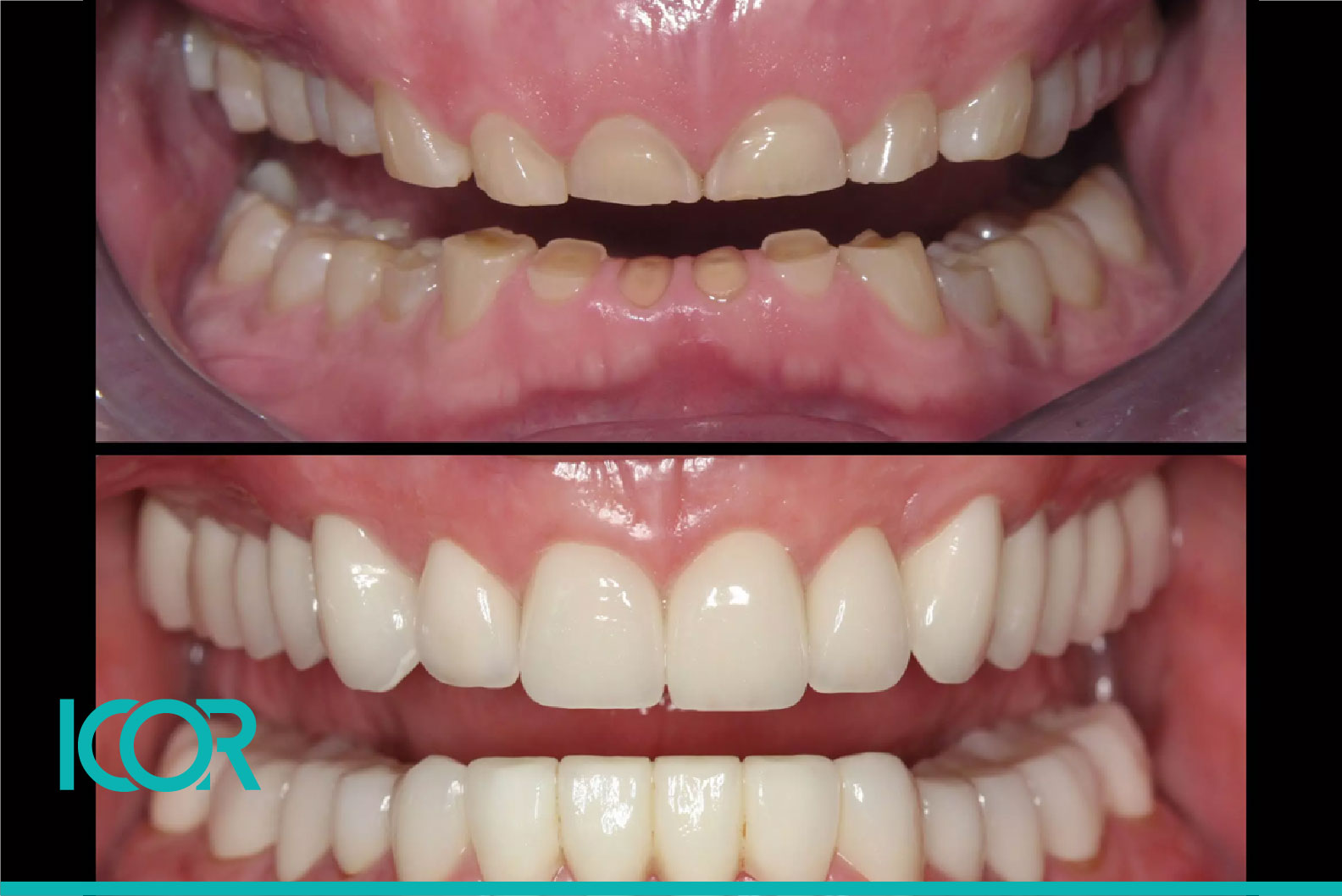 Antes y después Desgaste dentario
